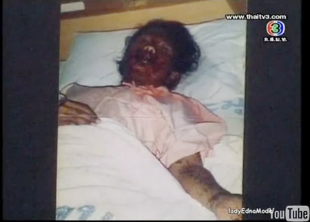 วรรณา สว่างโชติ แพ้ยาหน้าเป็นศพ แต่ผ่านมาได้เพราะรักจากสามี