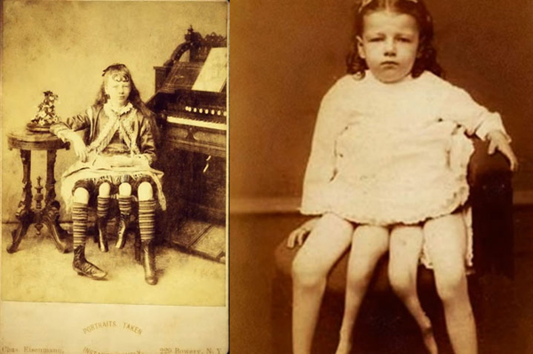 เมอร์เทิล คอร์บิน มนุษย์ 4 ขาที่มีอยู่จริงในประวัติศาสตร์