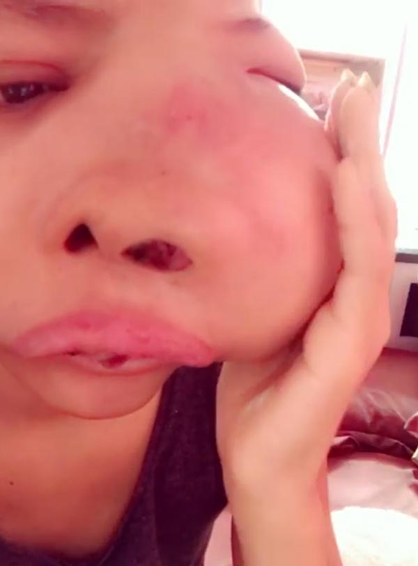 ป่วยมะเร็งจนหน้าบวม ป่วยมะเร็งจนหน้าบวม