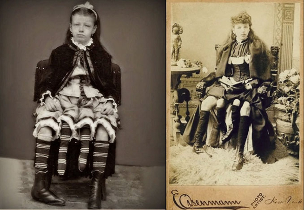 เมอร์เทิล คอร์บิน มนุษย์ 4 ขาที่มีอยู่จริงในประวัติศาสตร์