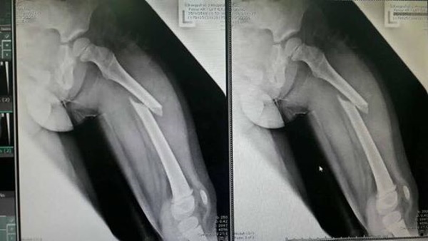 เล่นสไลเดอร์ที่สวนน้ำจนขาหัก เล่นสไลเดอร์ที่สวนน้ำจนขาหัก