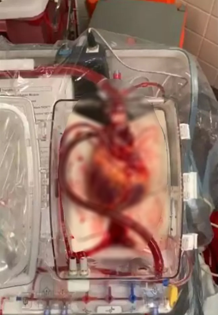 ปลูกถ่ายหัวใจ ปลูกถ่ายหัวใจ