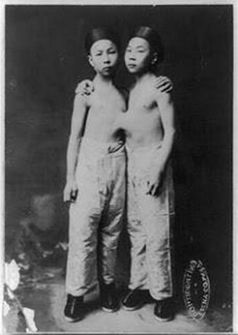 แฝดสยาม แฝดสยาม