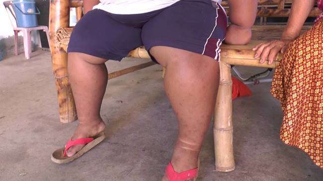 เด็ก 11 ขวบ หนัก 150 กก. เด็ก 11 ขวบ หนัก 150 กก.