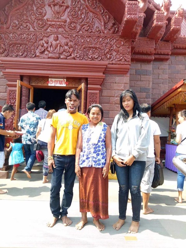 หนุ่มพิการใบหน้า เข้าพิธีผูกข้อมือสาวสวย หนุ่มพิการใบหน้า เข้าพิธีผูกข้อมือสาวสวย