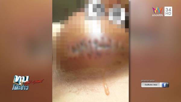 สาวผ่าตัดเสริมอึ๋ม สุดท้ายหน้าอกเน่า สาวผ่าตัดเสริมอึ๋ม สุดท้ายหน้าอกเน่า