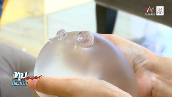 สาวผ่าตัดเสริมอึ๋ม สุดท้ายหน้าอกเน่า สาวผ่าตัดเสริมอึ๋ม สุดท้ายหน้าอกเน่า