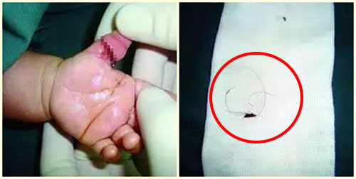 หนูน้อยวัย 2 เดือน หวิดเสียนิ้วโป้ง หลังเส้นผมแม่รัดแน่นจนฝังติดเนื้อ ! หนูน้อยวัย 2 เดือน หวิดเสียนิ้วโป้ง หลังเส้นผมแม่รัดแน่นจนฝังติดเนื้อ !