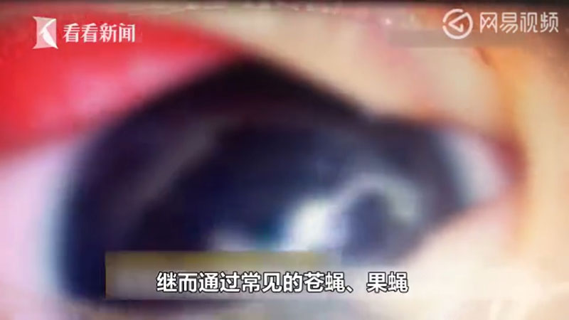 ผงะ.. พบพยาธิยั้วเยี้ยในตาทารก 5 เดือน คีบออกมาได้ 11 ตัว คาดติดจากสัตว์เลี้ยง ผงะ.. พบพยาธิยั้วเยี้ยในตาทารก 5 เดือน คีบออกมาได้ 11 ตัว คาดติดจากสัตว์เลี้ยง