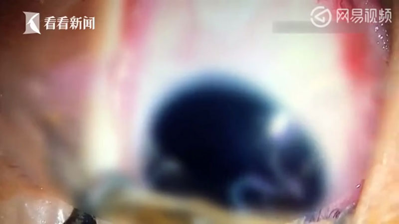 ผงะ.. พบพยาธิยั้วเยี้ยในตาทารก 5 เดือน คีบออกมาได้ 11 ตัว คาดติดจากสัตว์เลี้ยง ผงะ.. พบพยาธิยั้วเยี้ยในตาทารก 5 เดือน คีบออกมาได้ 11 ตัว คาดติดจากสัตว์เลี้ยง