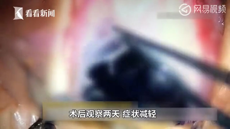 ผงะ.. พบพยาธิยั้วเยี้ยในตาทารก 5 เดือน คีบออกมาได้ 11 ตัว คาดติดจากสัตว์เลี้ยง ผงะ.. พบพยาธิยั้วเยี้ยในตาทารก 5 เดือน คีบออกมาได้ 11 ตัว คาดติดจากสัตว์เลี้ยง