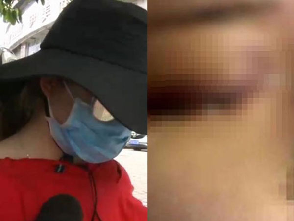 ฉีดฟิลเลอร์ ฉีดฟิลเลอร์