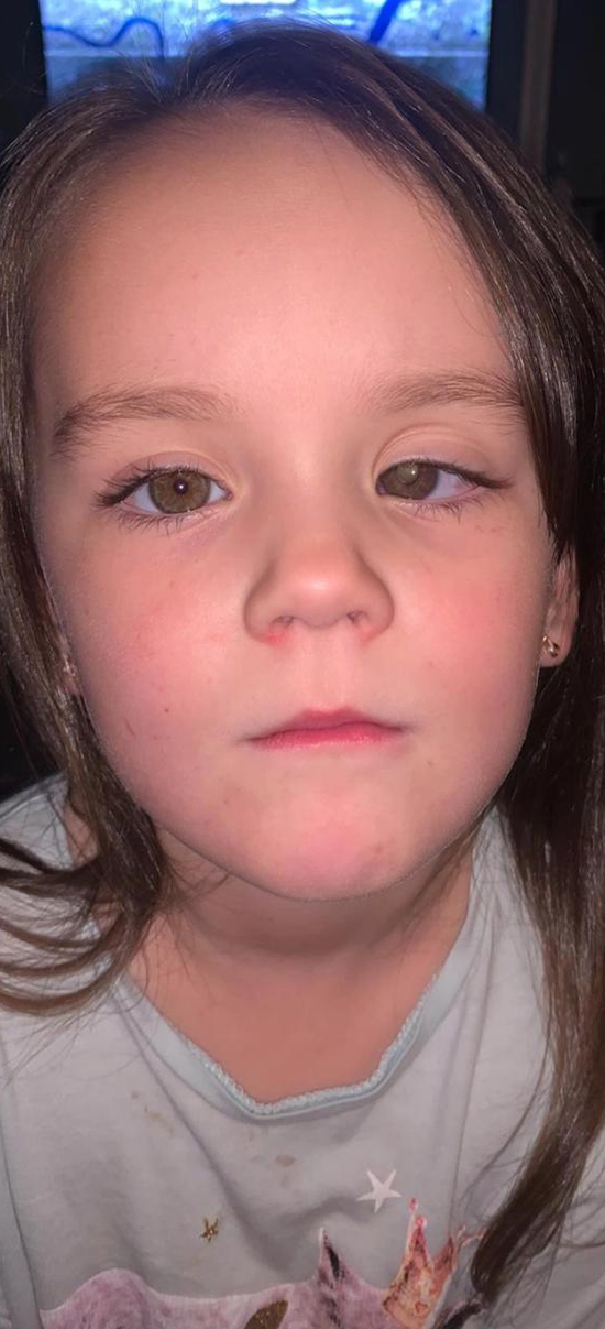 โรคมะเร็งจอตาในเด็ก โรคมะเร็งจอตาในเด็ก