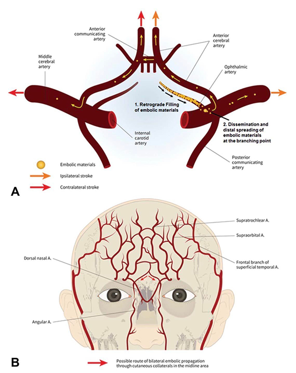 เตือนภัยฉีดฟิลเลอร์ เตือนภัยฉีดฟิลเลอร์