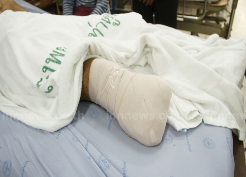 ทหารพรานสุรินทร์ เหยียบกับระเบิดขาขาด 1 บาดเจ็บ 2