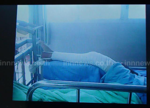 พ่อแม่ร้องสื่อ ลูกชาย ป.3 ถูกรุ่นพี่เตะขาหัก ไม่มีใครรับผิดชอบ พ่อแม่ร้องสื่อ ลูกชาย ป.3 ถูกรุ่นพี่เตะขาหัก ไม่มีใครรับผิดชอบ