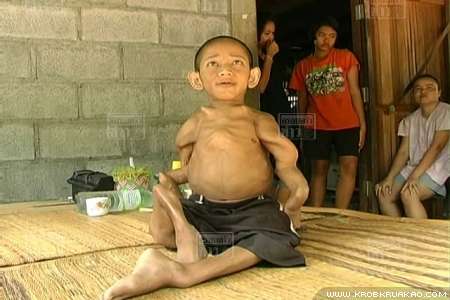 ชายวัย 37 ป่วยโรคกระดูกพรุน ตัวหดเท่าเด็ก 2 ขวบ ชายวัย 37 ป่วยโรคกระดูกพรุน ตัวหดเท่าเด็ก 2 ขวบ