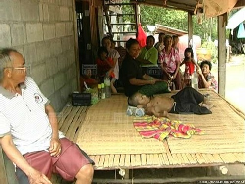 ชายวัย 37 ป่วยโรคกระดูกพรุน ตัวหดเท่าเด็ก 2 ขวบ ชายวัย 37 ป่วยโรคกระดูกพรุน ตัวหดเท่าเด็ก 2 ขวบ