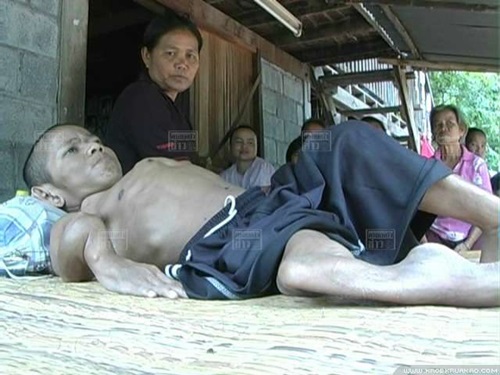 ชายวัย 37 ป่วยโรคกระดูกพรุน ตัวหดเท่าเด็ก 2 ขวบ ชายวัย 37 ป่วยโรคกระดูกพรุน ตัวหดเท่าเด็ก 2 ขวบ