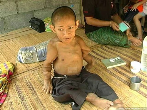 ชายวัย 37 ป่วยโรคกระดูกพรุน ตัวหดเท่าเด็ก 2 ขวบ ชายวัย 37 ป่วยโรคกระดูกพรุน ตัวหดเท่าเด็ก 2 ขวบ