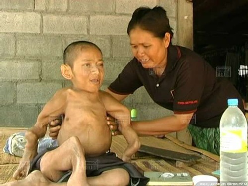 ชายวัย 37 ป่วยโรคกระดูกพรุน ตัวหดเท่าเด็ก 2 ขวบ ชายวัย 37 ป่วยโรคกระดูกพรุน ตัวหดเท่าเด็ก 2 ขวบ