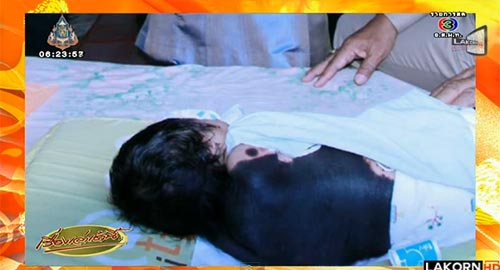 น้องน้ำใจ หนูน้อยปานดำเต็มตัว เสียชีวิตแล้ว น้องน้ำใจ หนูน้อยปานดำเต็มตัว เสียชีวิตแล้ว