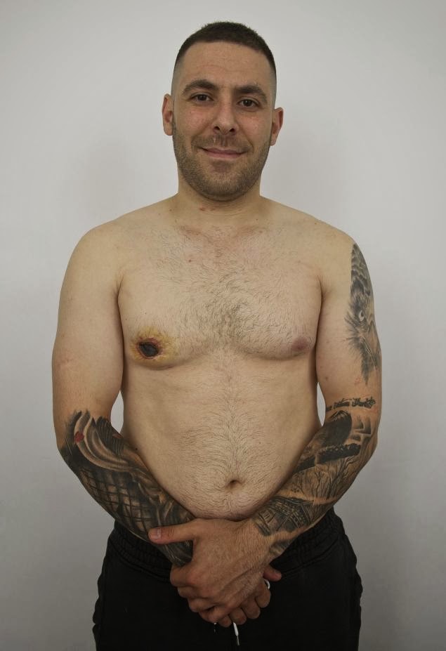 ชายอังกฤษสุดอาย มีนมข้างหนึ่งเป็นเต้าเหมือนผู้หญิง ชายอังกฤษสุดอาย มีนมข้างหนึ่งเป็นเต้าเหมือนผู้หญิง