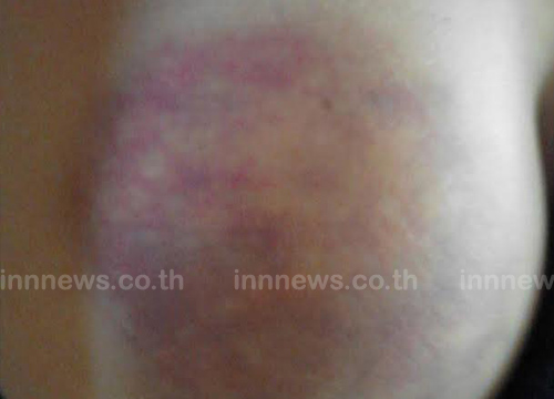 แม่โวย ครูทำโทษลูกเกินกว่าเหตุ ตีก้น 80 ที แม่โวย ครูทำโทษลูกเกินกว่าเหตุ ตีก้น 80 ที