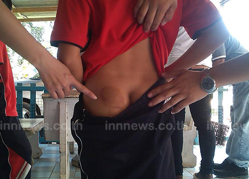 แม่โวย ครูทำโทษลูกเกินกว่าเหตุ ตีก้น 80 ที แม่โวย ครูทำโทษลูกเกินกว่าเหตุ ตีก้น 80 ที