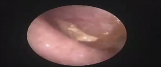 หนอนในหูคน หนอนในหูคน