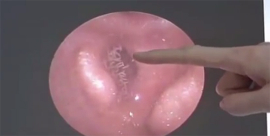 หนอนในหูคน หนอนในหูคน