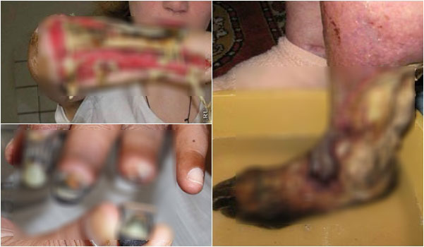Krokodil ยาเสพติดเสพแล้วเนื้อหลุด คอนเฟิร์มมีจริง Krokodil ยาเสพติดเสพแล้วเนื้อหลุด คอนเฟิร์มมีจริง