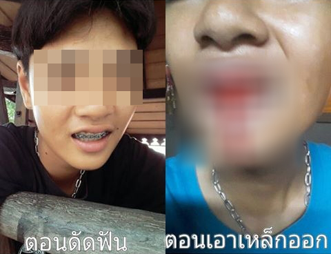 ดัดฟันแฟชั่น ดัดฟันแฟชั่น