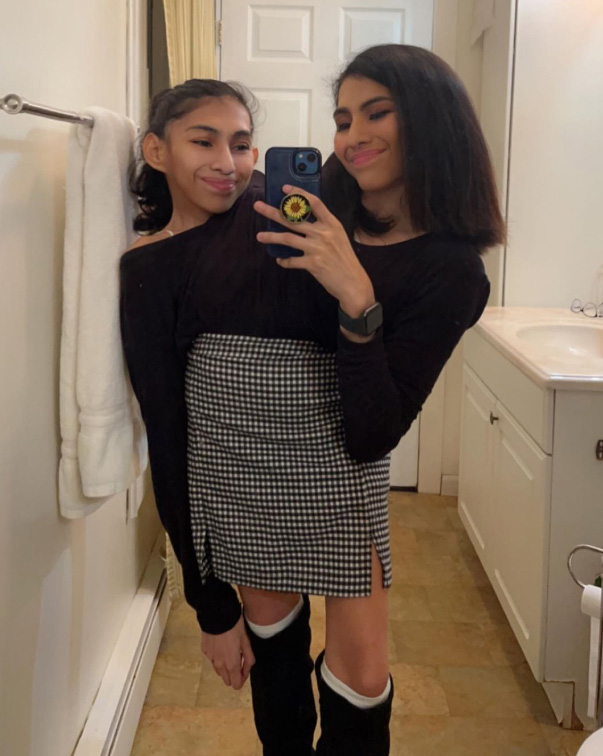 ฝาแฝดตัวติดกัน ฝาแฝดตัวติดกัน