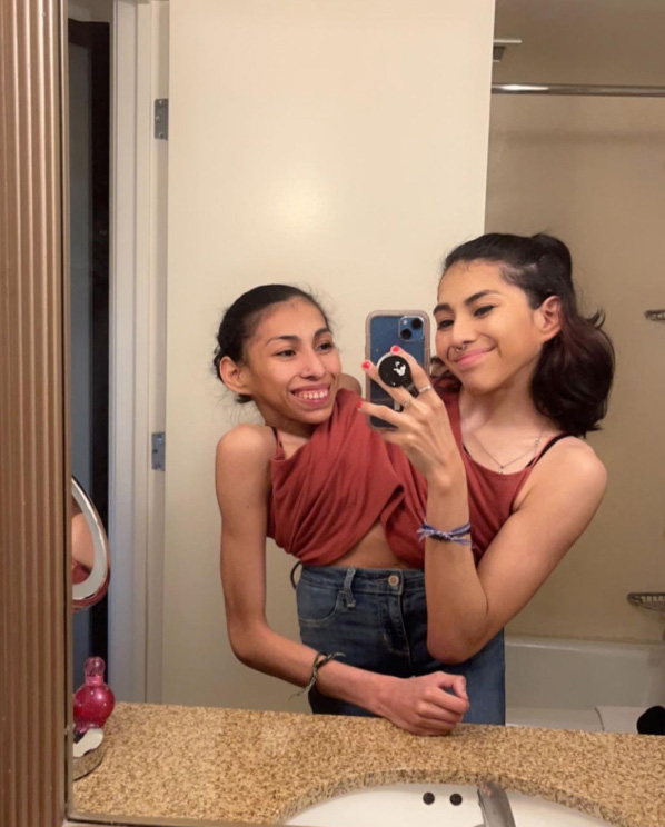 ฝาแฝดตัวติดกัน ฝาแฝดตัวติดกัน