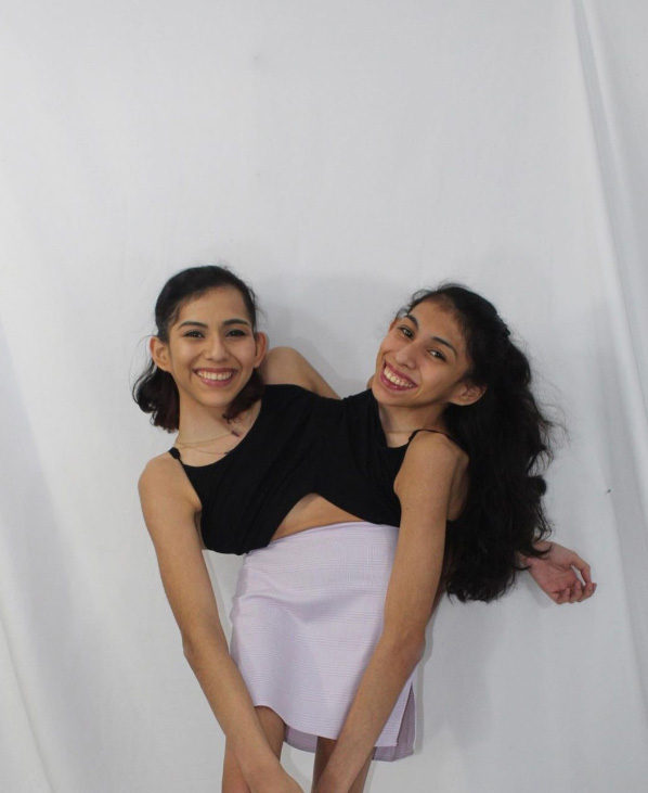 ฝาแฝดตัวติดกัน ฝาแฝดตัวติดกัน