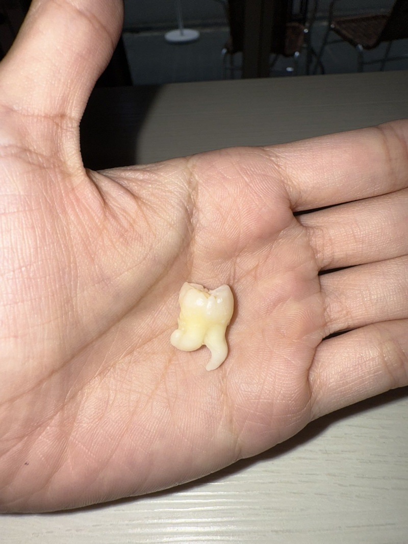 ภาพฟันคุดสาวญี่ปุ่น กลายเป็นไวรัล 17 ล้าน ภาพฟันคุดสาวญี่ปุ่น กลายเป็นไวรัล 17 ล้าน