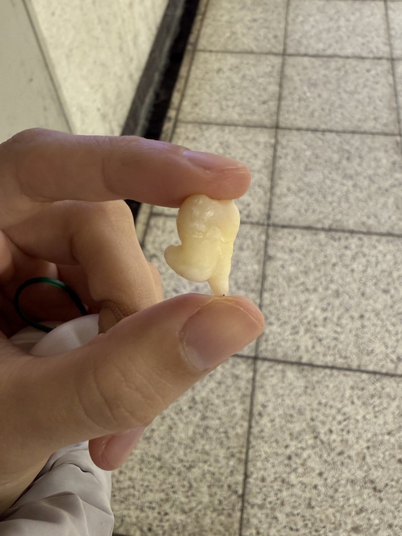 ภาพฟันคุดสาวญี่ปุ่น กลายเป็นไวรัล 17 ล้าน ภาพฟันคุดสาวญี่ปุ่น กลายเป็นไวรัล 17 ล้าน