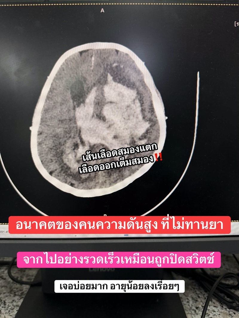 คนไข้ความดันโลหิตสูงไม่ยอมกินยา สมองจะเป็นแบบนี้ คนไข้ความดันโลหิตสูงไม่ยอมกินยา สมองจะเป็นแบบนี้