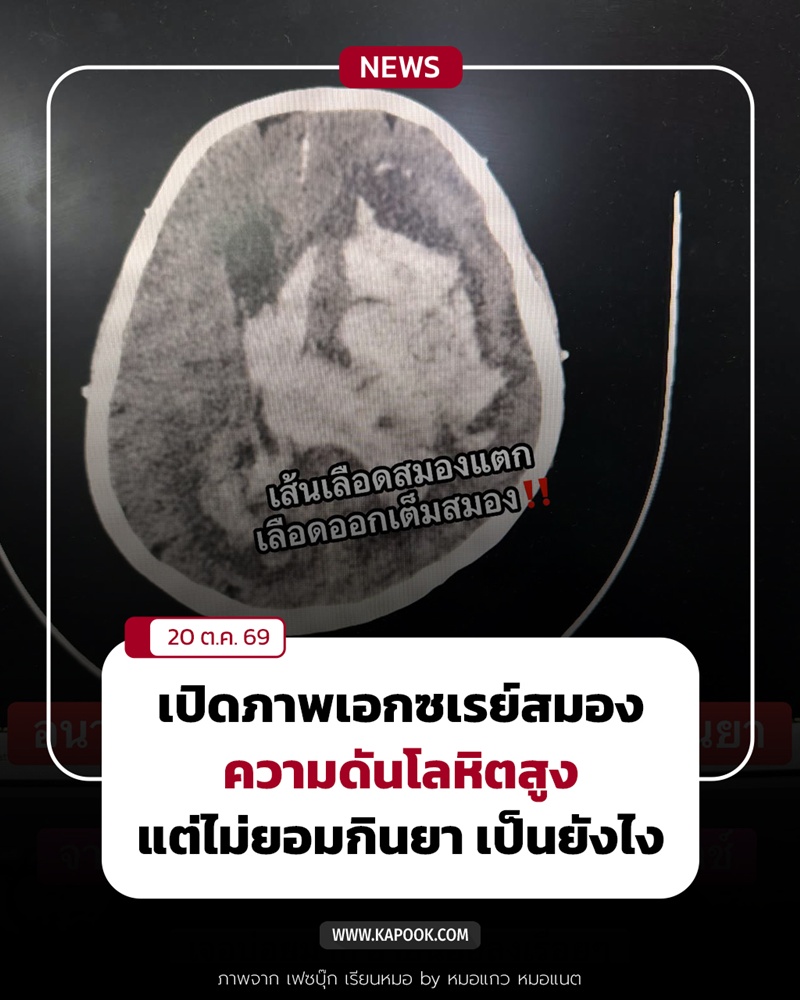 คนไข้ความดันโลหิตสูงไม่ยอมกินยา สมองจะเป็นแบบนี้ คนไข้ความดันโลหิตสูงไม่ยอมกินยา สมองจะเป็นแบบนี้