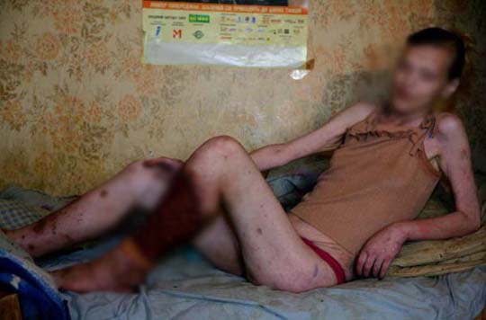 Krokodil ยาเสพติดมรณะ Krokodil ยาเสพติดมรณะ