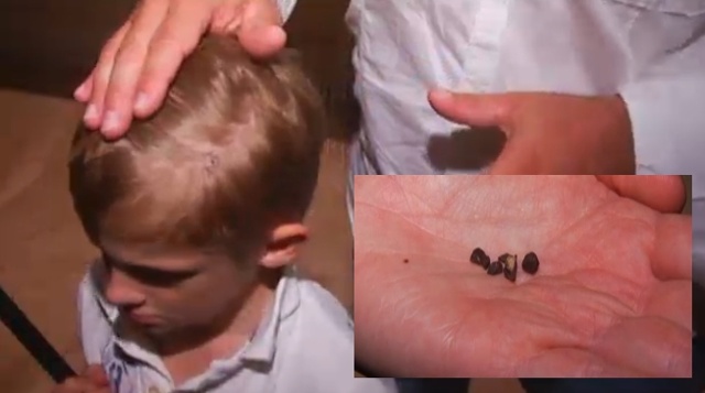 เด็กมะกันถูกเศษอุกกาบาตตกใส่ หัวแตกเย็บ 3 เข็ม เด็กมะกันถูกเศษอุกกาบาตตกใส่ หัวแตกเย็บ 3 เข็ม