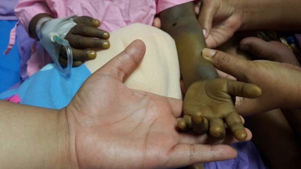 น้องแป้ง ป่วยโรคตับ น้องแป้ง ป่วยโรคตับ