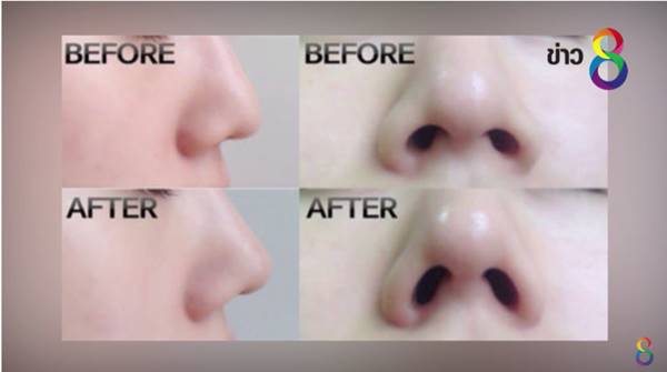 โนส ซีเคร็ต (Nose Secret) โนส ซีเคร็ต (Nose Secret)