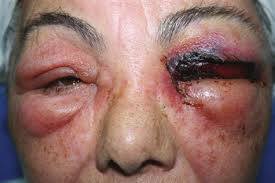 แมงมุมสันโดษเมดิเตอร์เรเนียน แมงมุมสันโดษเมดิเตอร์เรเนียน