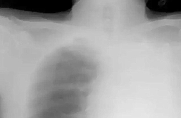 ปอดหาย ปอดหาย