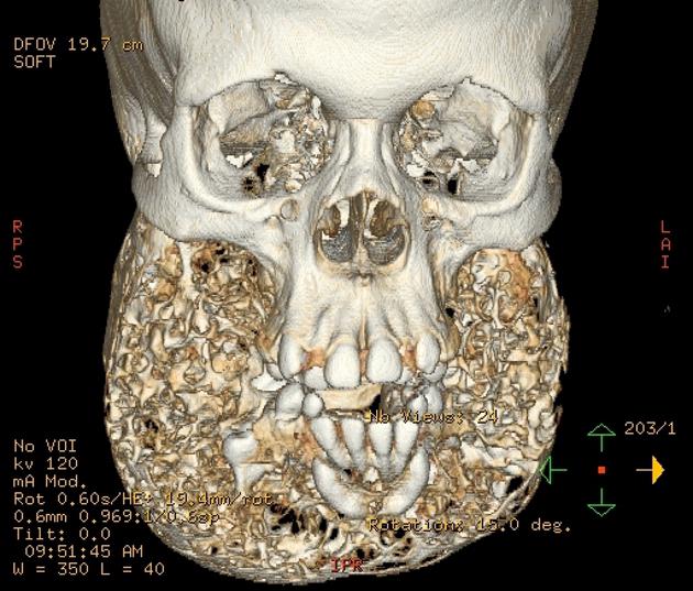 โรค Cherubism โรค Cherubism