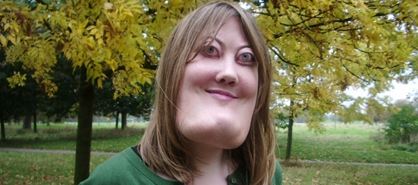 โรค Cherubism โรค Cherubism