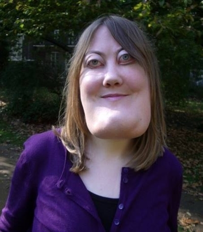 โรค Cherubism โรค Cherubism