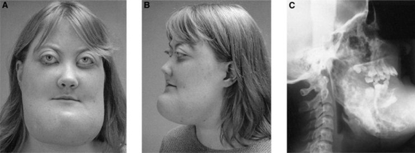 โรค Cherubism โรค Cherubism